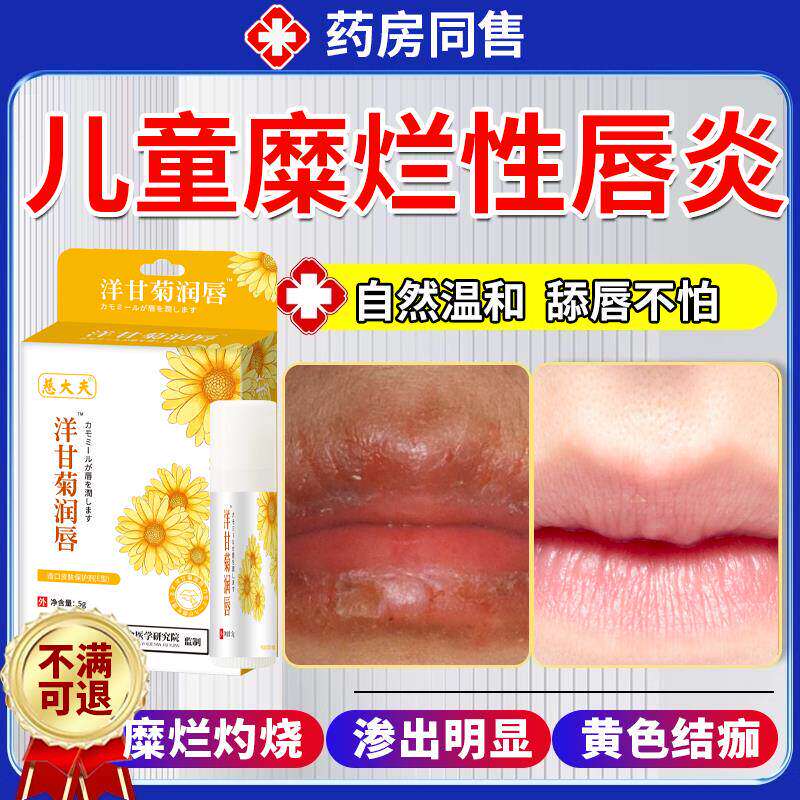儿童糜烂性唇炎唇膏嘴唇防干裂脱皮专用医用退热凝胶口角炎FB