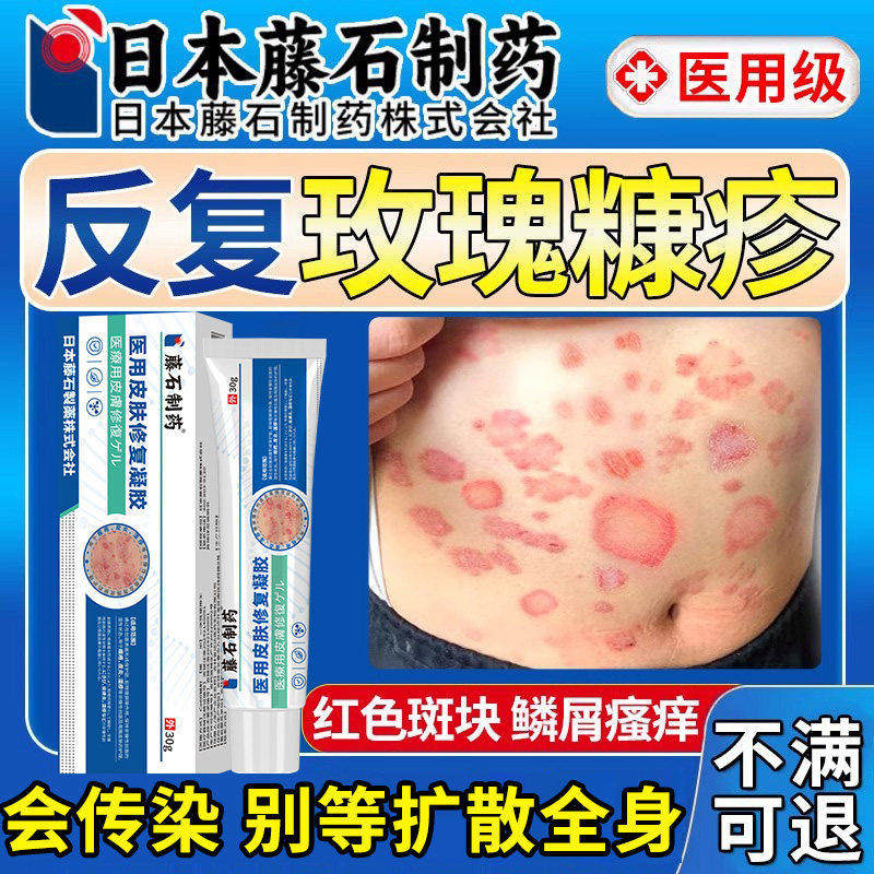 玫瑰糠疹皮肤瘙痒红斑专用