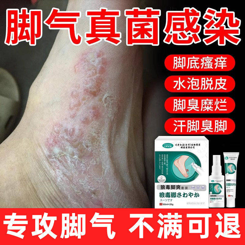 日本脚气止痒脱皮杀菌真感