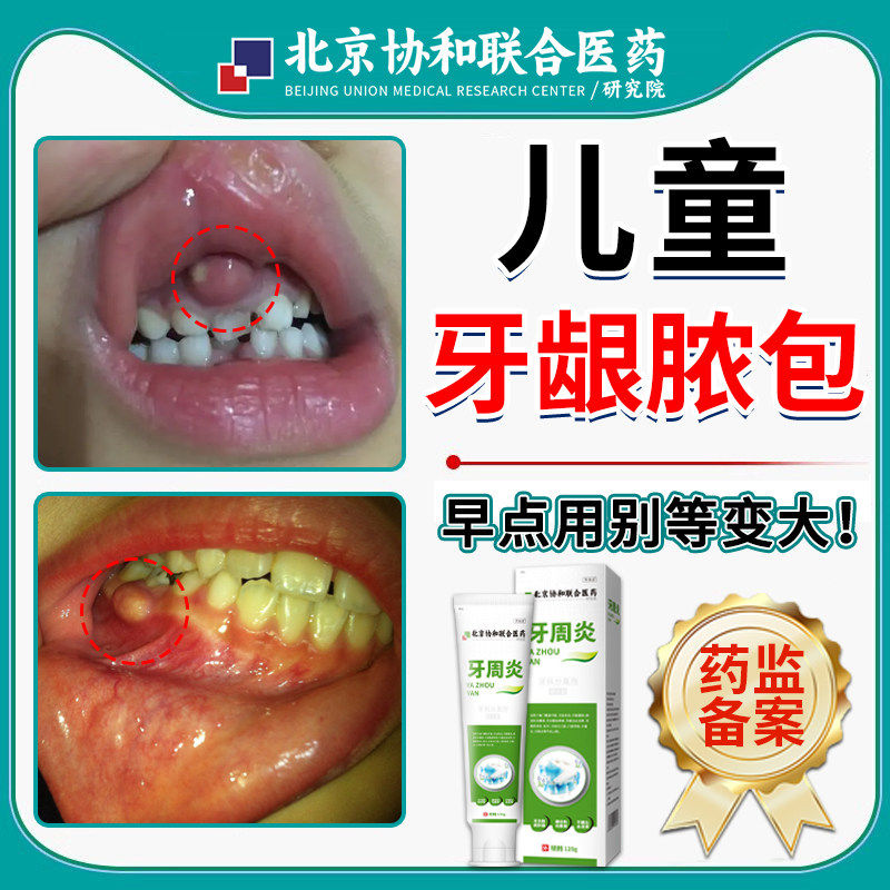 儿童牙龈长脓包肿痛根肉上