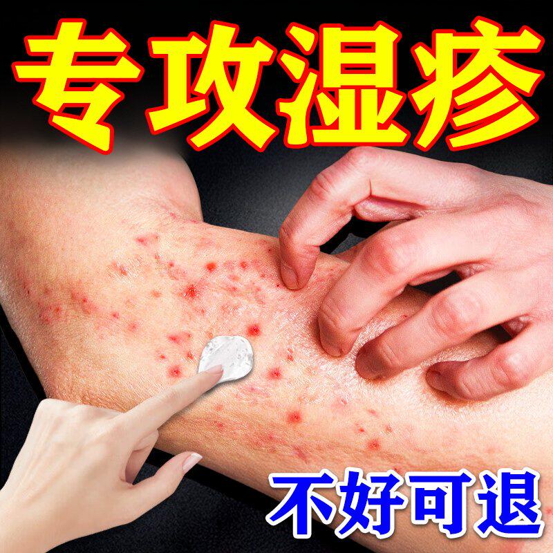 湿疹止痒去顽固专用慢性皮炎皮肤瘙痒外用膏干燥全身痒抑菌膏