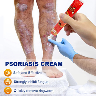极速20g Psoriasis Ointment Exczema Treat Hand Tinea Foot Odo