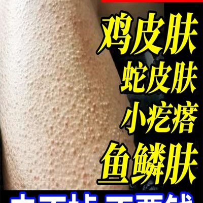 速发儿童腿上有鸡皮肤疙瘩毛周角化毛囊角质症去除全身胳膊手臂脸
