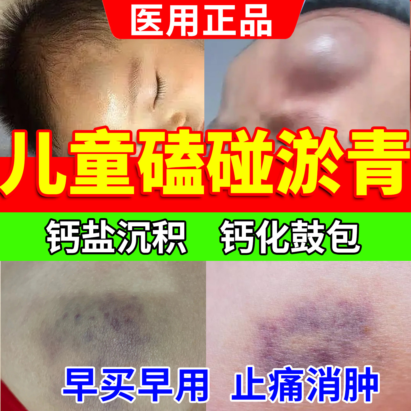 儿童宝宝淤青膏磕碰摔伤跌打损伤活血化瘀舒筋快速消肿止痛外用u9