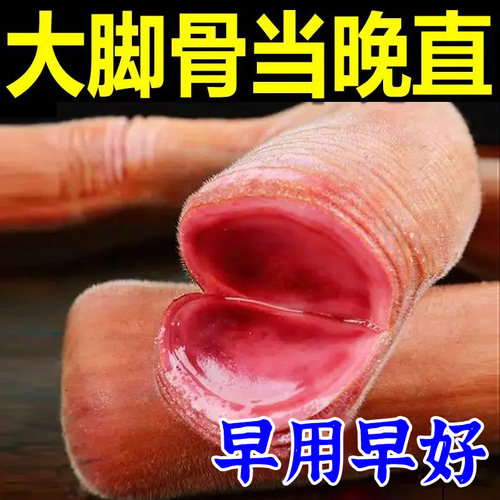 极速拇指c外翻贴大脚骨变形突出矫正器脚趾重叠严重拇外翻专用膏