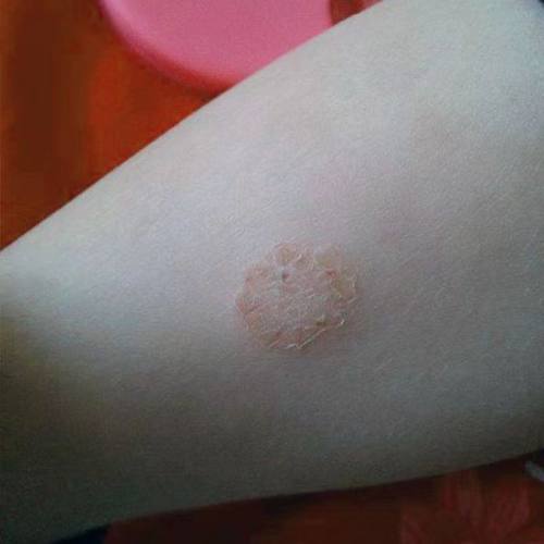 极速大腿内侧烧档感染大腿内侧发E红潮湿瘙痒烧档淹档疼痛湿疹