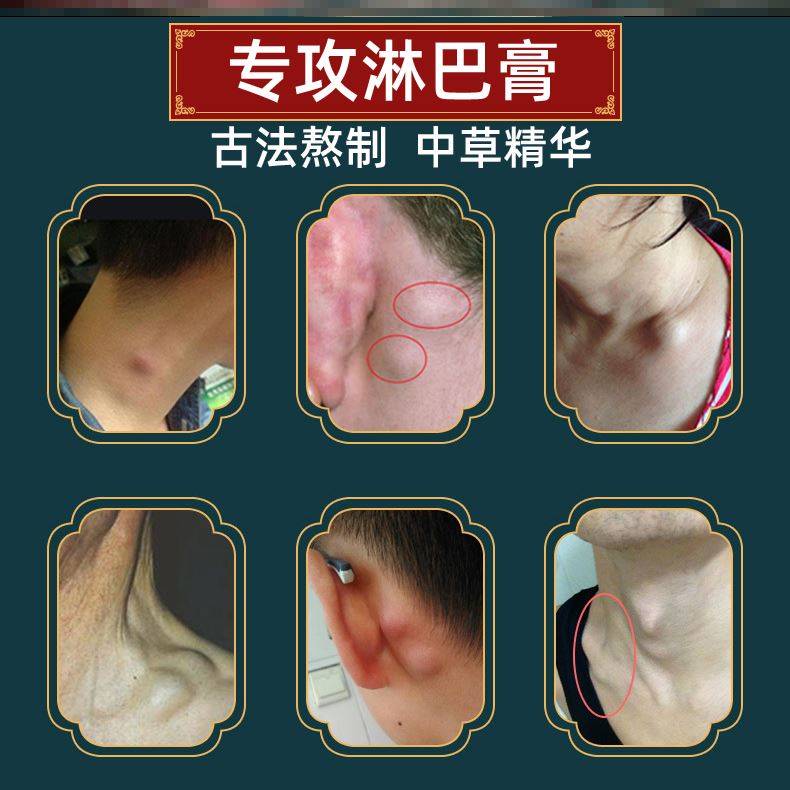 新品蒲公英散结膏夏枯草膏甲状腺B膏结节去副乳神器消除贴消淋巴