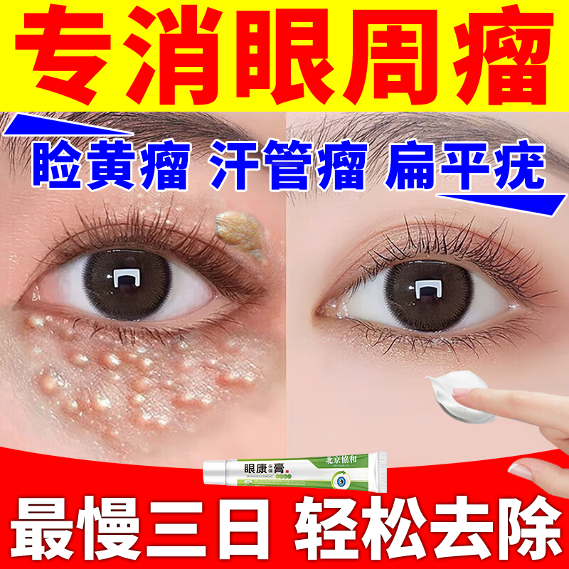 眼睑黄瘤去除神器膏药汗管瘤疙瘩