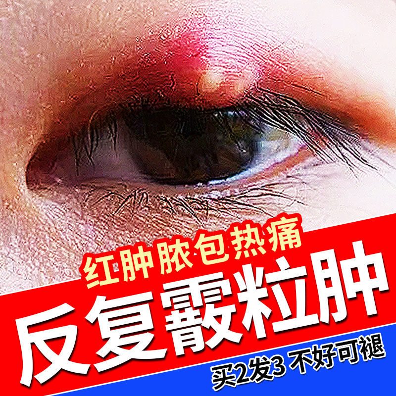 霰粒肿热敷眼贴眼睑板堵塞儿童