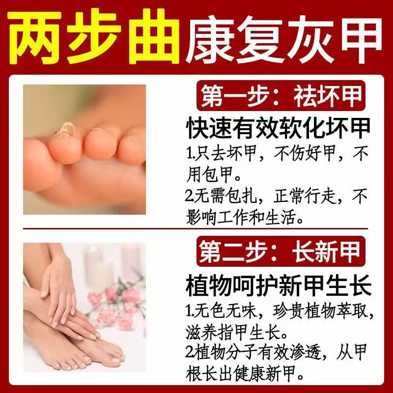 极速黑指甲药甲母痣n手脚趾有淤血黑线分层厚黄抑挤压变黑菌液