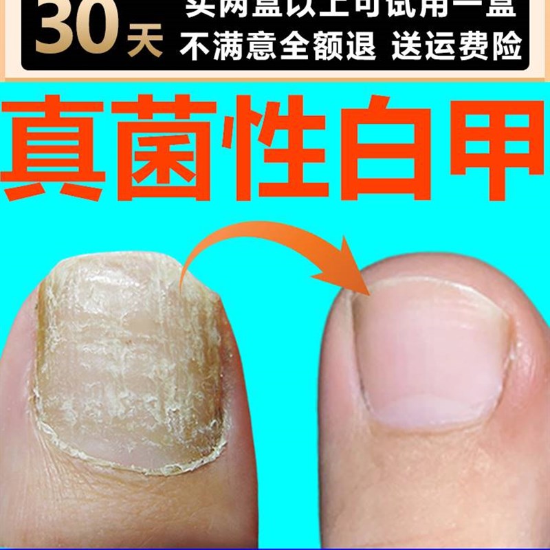 极速性白甲脚指甲盖变厚发黄指甲修复液受损再S生甲床甲肉分离.