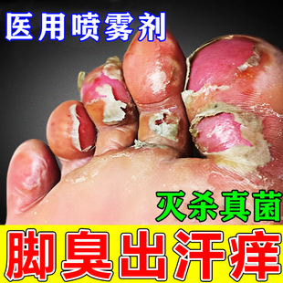 脚臭根去专用特药效汗脚气烂脚丫药脱皮糜烂脚趾真菌感染喷雾剂