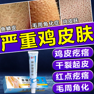 去鸡皮肤疙瘩毛囊角质化非身体乳毛周角化症去除神器水杨酸软膏