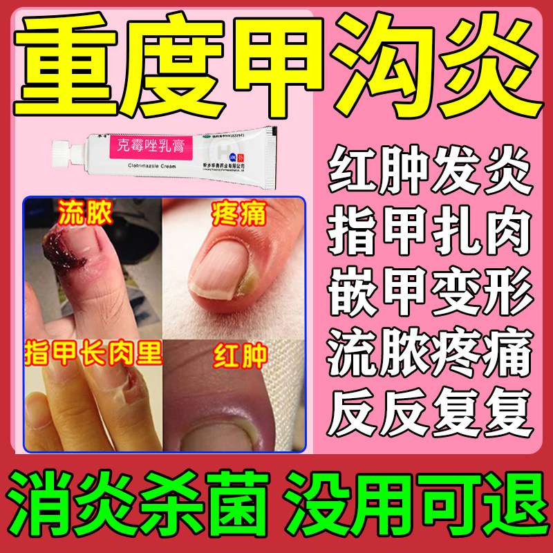 甲沟炎治疗特专效用药膏脚大拇指甲沟炎趾甲往肉里长念珠菌性正品