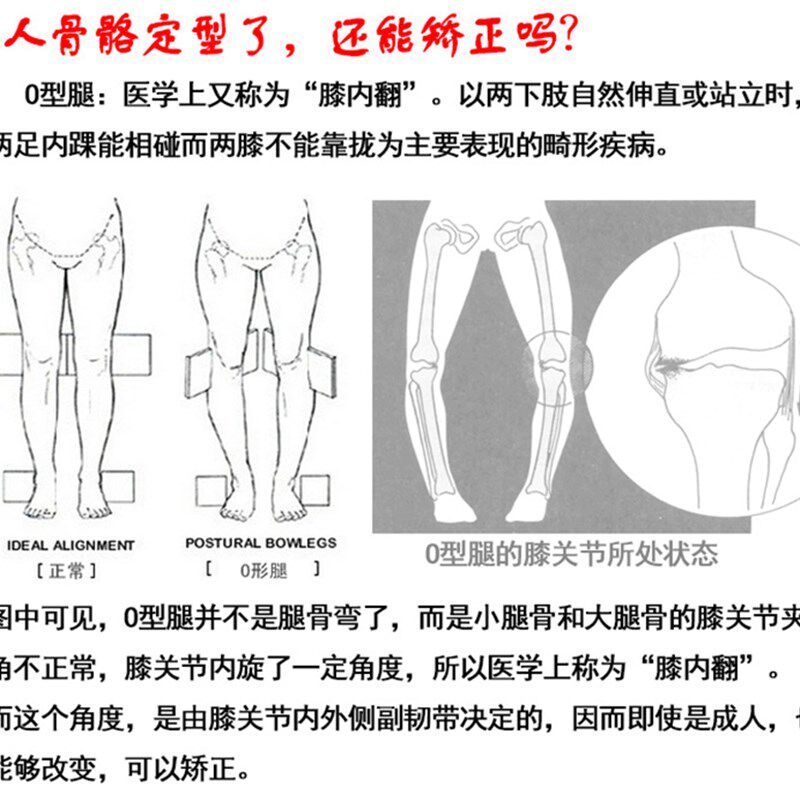 儿童X形腿O型腿矫正带身姿纠正直腿型弯曲内外八字绑腿带神器成人