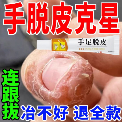 手脱皮严重专用真菌蜕治干