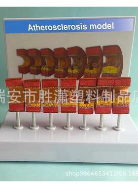 动脉病变硬化模型 血管血栓栓塞模型动脉血管脂血管堵塞病态血管