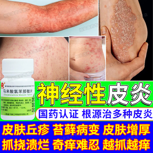 神经性皮炎口服药特应性效药日光性皮炎紫外线过敏晒伤瘙痒止湿疹