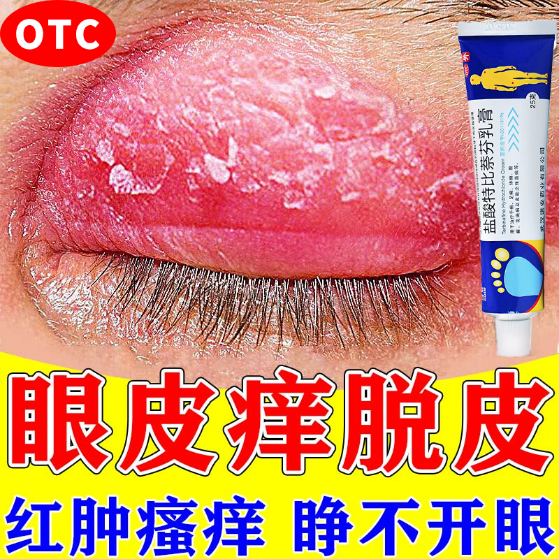 眼皮癣药膏眼睛周围眼角痒干燥起皮掉屑红肿过敏盐酸特比萘芬乳膏