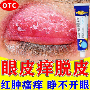 眼皮癣药膏眼睛周围眼角痒干燥起皮掉屑红肿过敏盐酸特比萘芬乳膏