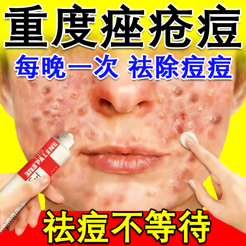 祛痘药膏阿达帕林凝胶正品官方旗舰店医用痤疮膏祛痘痘印重度暗疮
