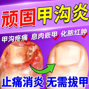 甲沟炎治疗专用特根效药膏治第一指甲名软化剂息肉去除神长肉里器