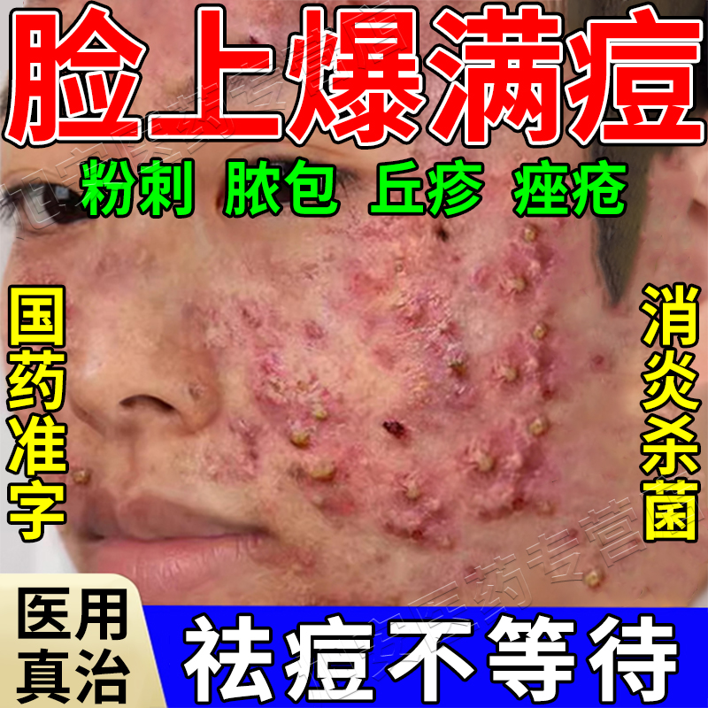 胶态太肽硫软膏祛痘医用专业杀菌祛痘外用软膏国药监局准字酒糟鼻