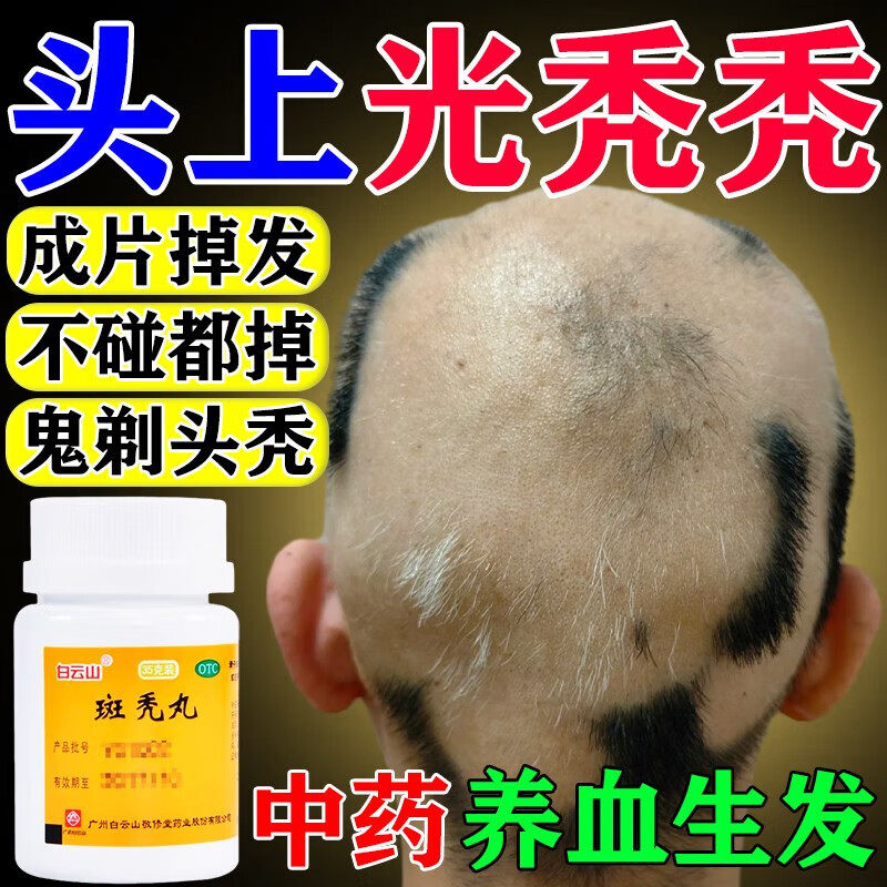 斑秃丸特专用药新效期地中海男女头发成片脱落补肾养血生发