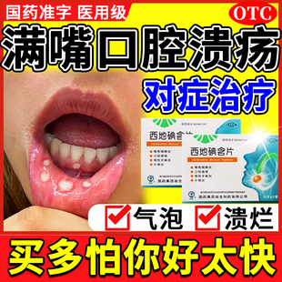 西地碘含片官方旗舰店反复口腔溃疡含片特华素效消炎进口专用药物