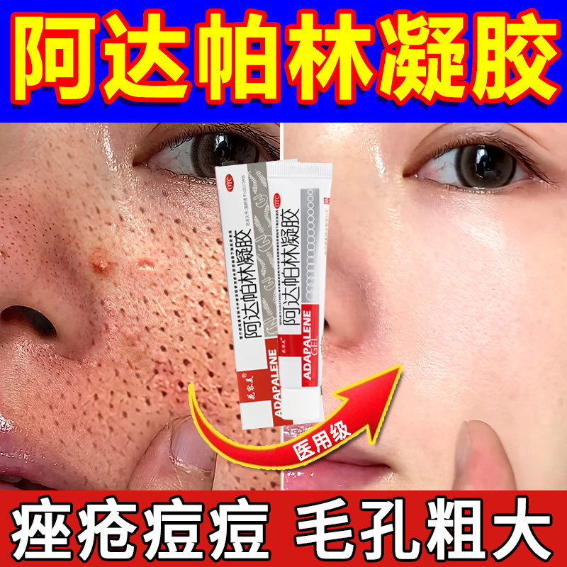 阿达帕林凝胶正品官方旗舰店青少年医用软膏去黑头毛孔粗大达芙文