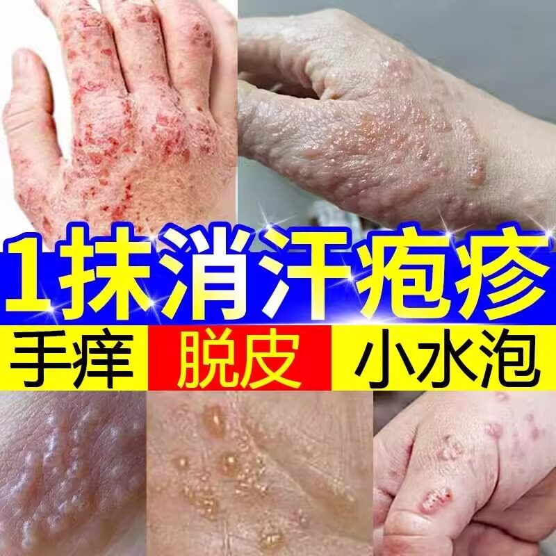 日本汗疱疹止痒药膏汗疱疹手足干裂脱皮瘙痒长水泡修覆护理保湿膏