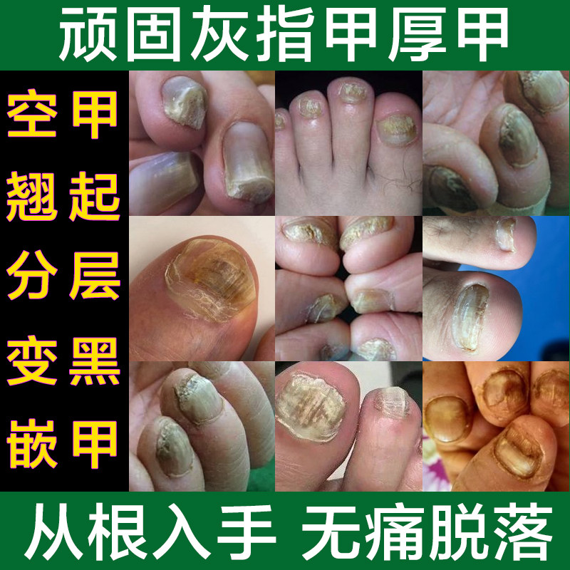 快速去灰指甲专用无痛脱甲膏 去除甲沟炎嵌甲叠甲指甲坏甲抑菌液