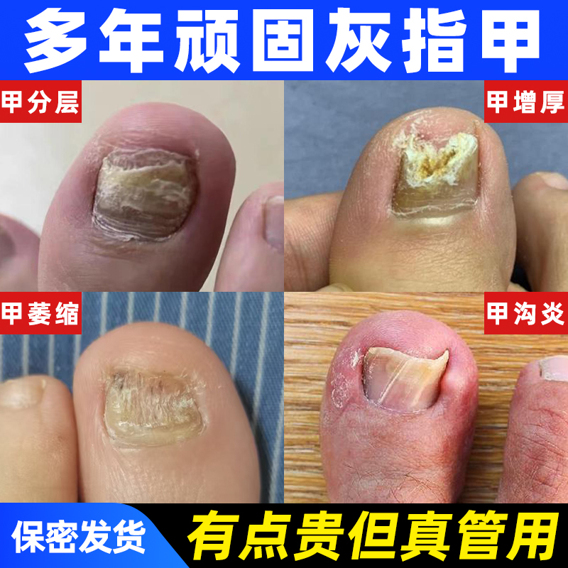 灰指甲无痛脱甲膏甲沟炎抑菌液快速脱甲精油脚趾甲嵌甲灰甲软化剂
