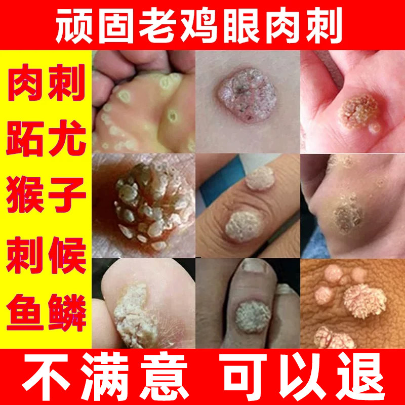 佰草钟医跖疣鸡眼膏寻常疣去除手上足部脚底脚趾上长鸡眼跖疣专用