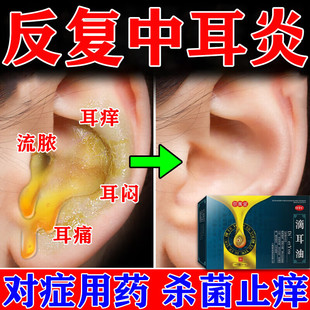 中耳炎专用药耳朵真菌感染耳痒发炎流脓耳鸣止痒抑菌消炎滴耳液G