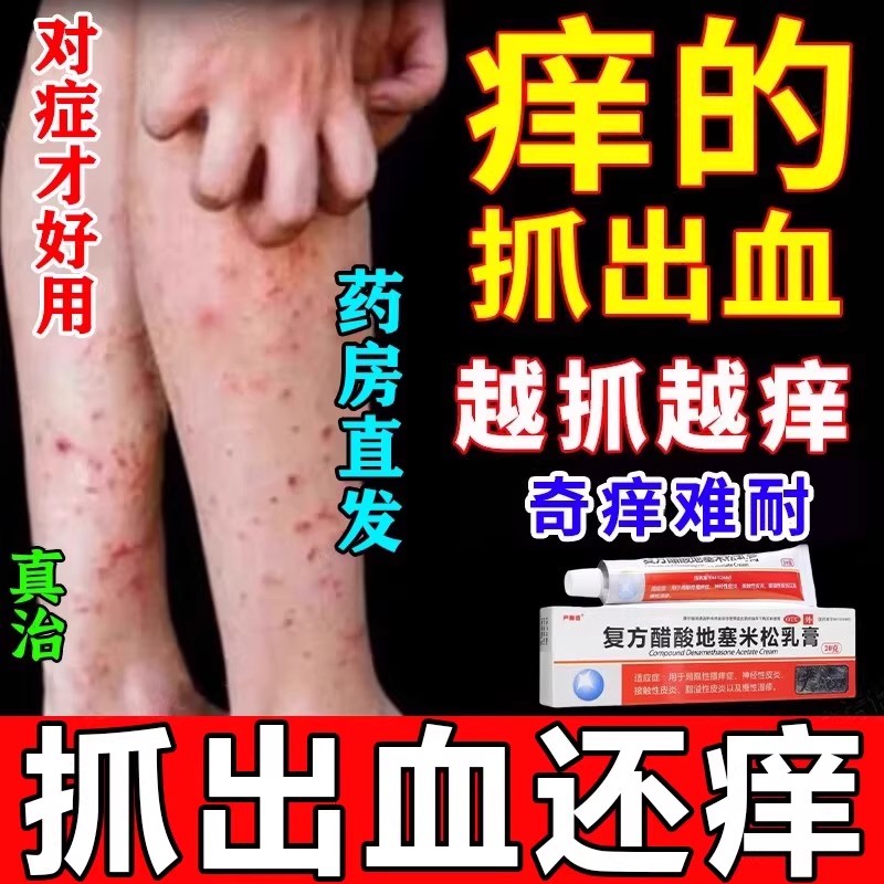 复方醋酸地塞米松乳膏除皮肤湿疹止痒药膏抑菌过敏皮炎平软膏正品