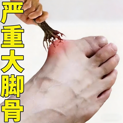 【已帮10万+】脚趾重叠防磨大脚骨拇指外翻矫正专用膏贴