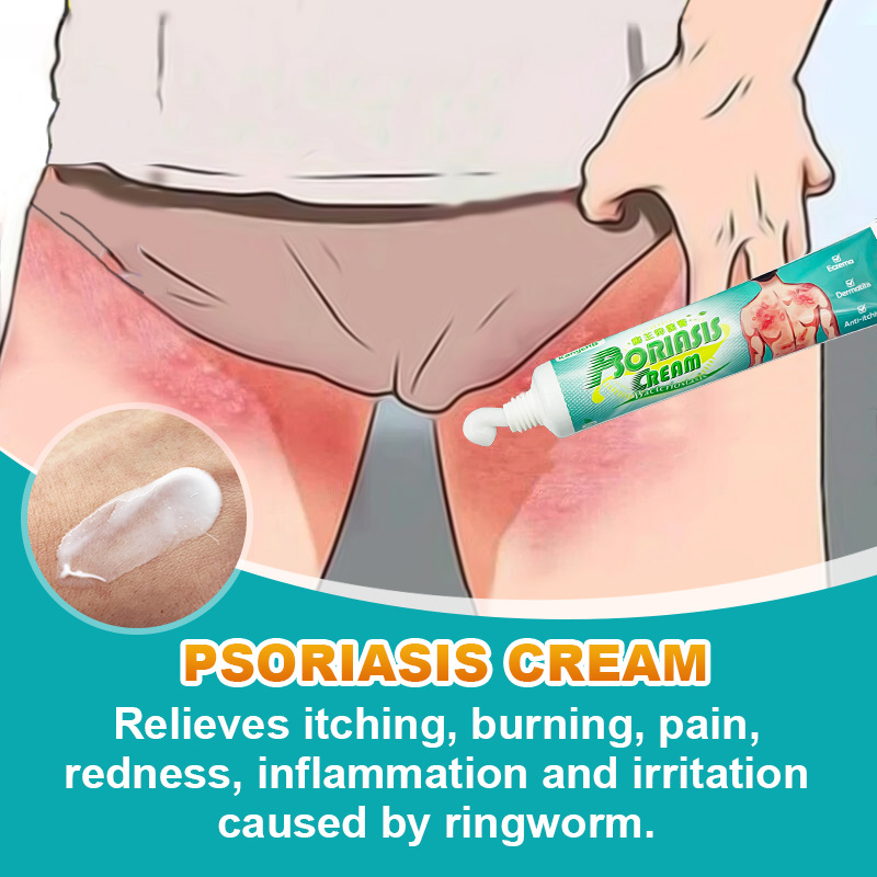 极速20g Skin Pskoriasis Cream Eczema Ointment Scalp Psoriasi