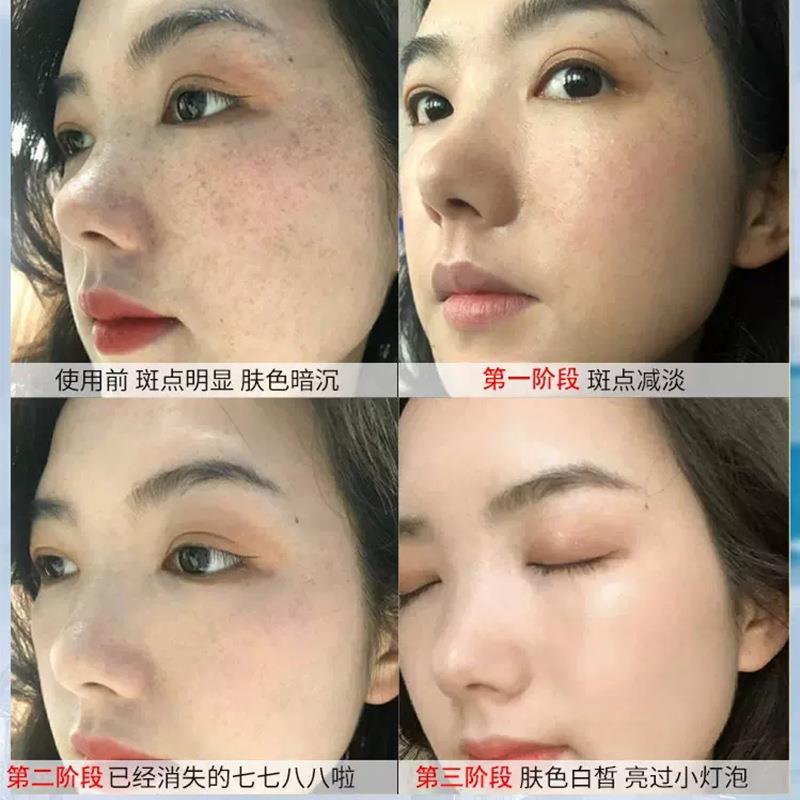 氨甲环酸乳膏去雀斑黄褐斑老年斑抑制黑色素传明酸美嫩白祛化斑霜