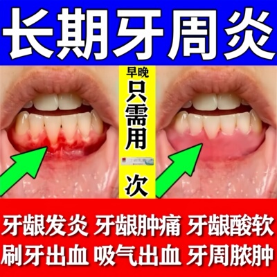 牙膏治疗药专用牙周炎口腔牙龈萎缩牙疼消炎牙龈肿痛丁硼乳膏正品