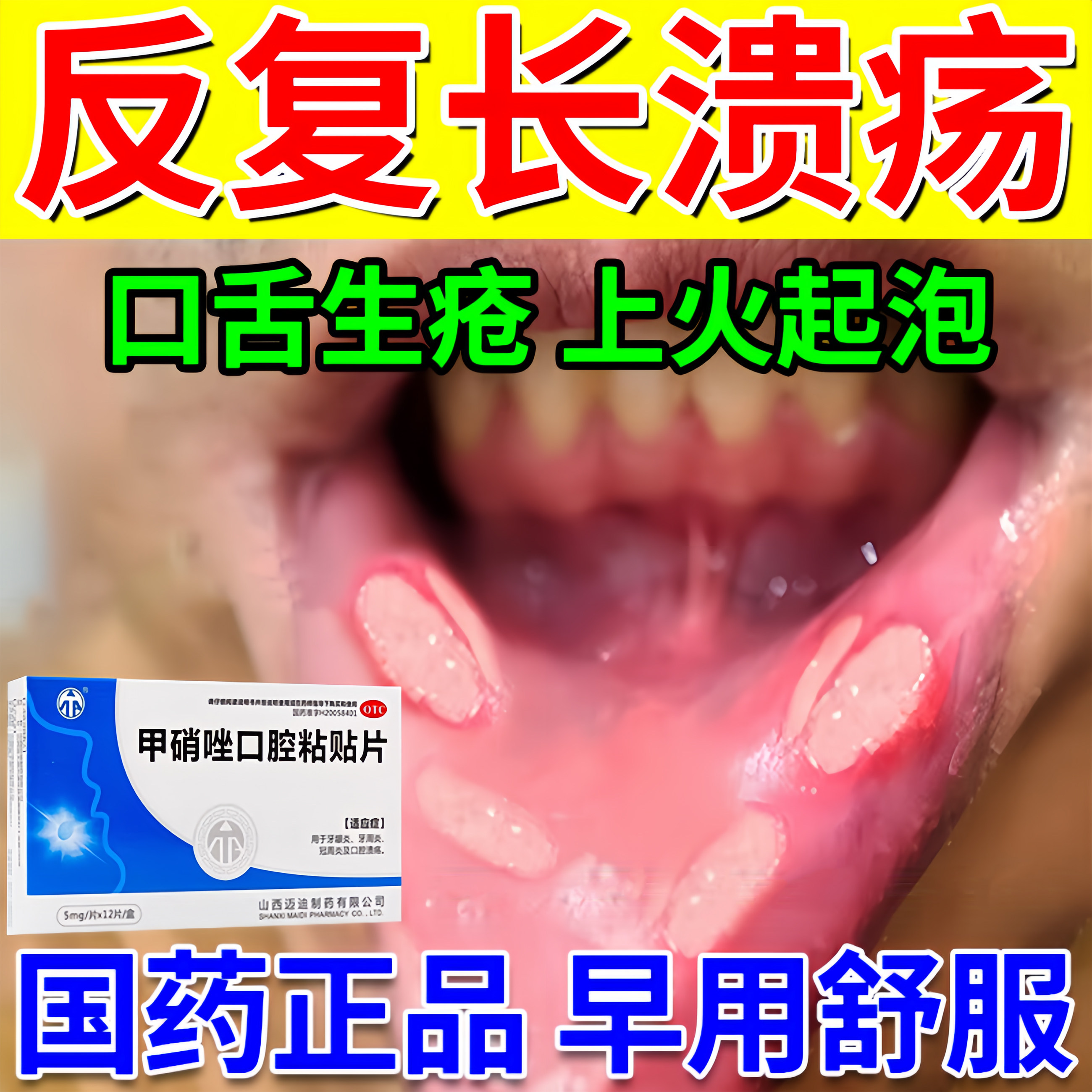 口腔溃疡贴嘴巴舌头上火起泡烂口舌生疮溃烂消炎甲硝唑口腔粘贴片