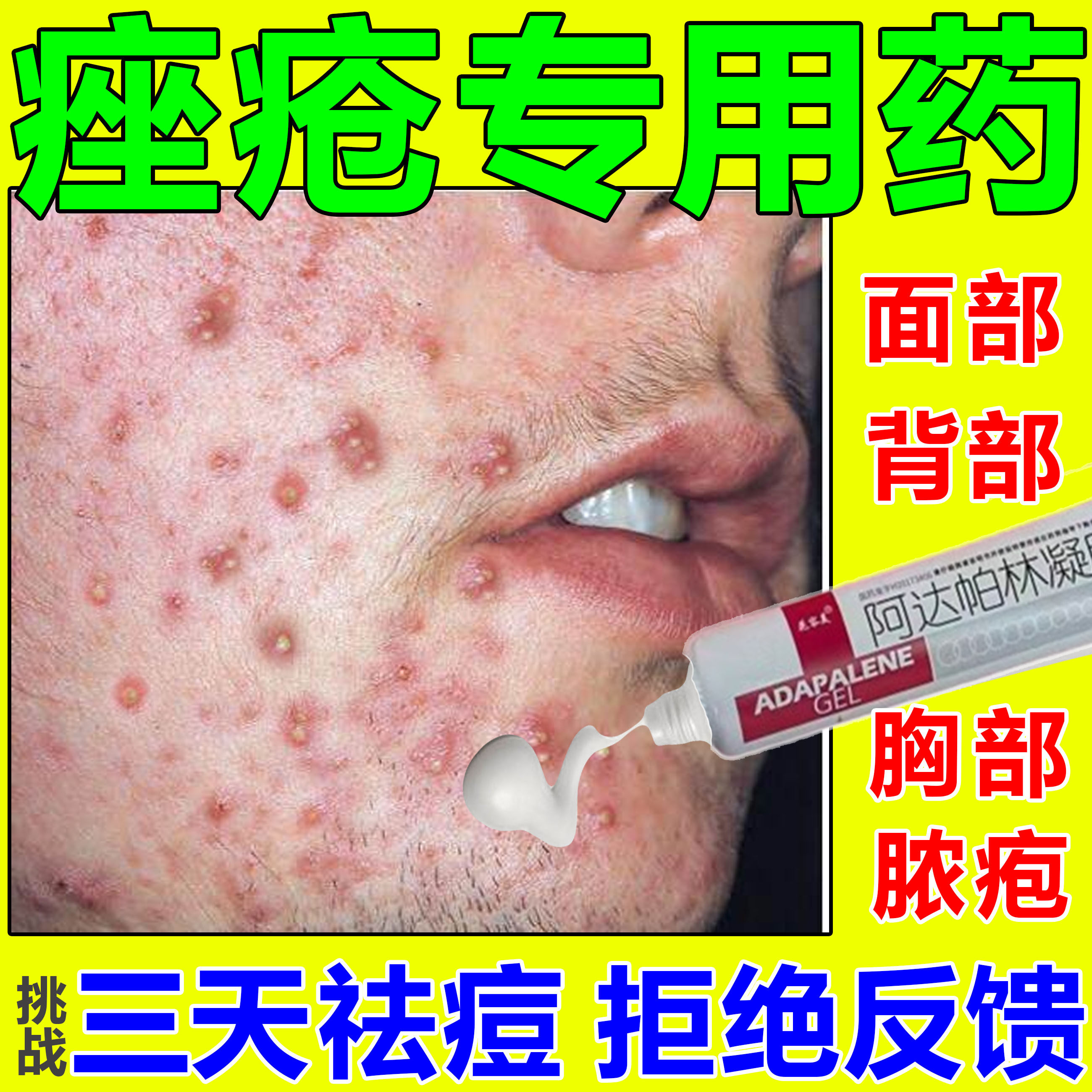 痤疮专用特效的药膏脸部背部胸部头部粉刺疙瘩脓疱红斑丘疹治疗药