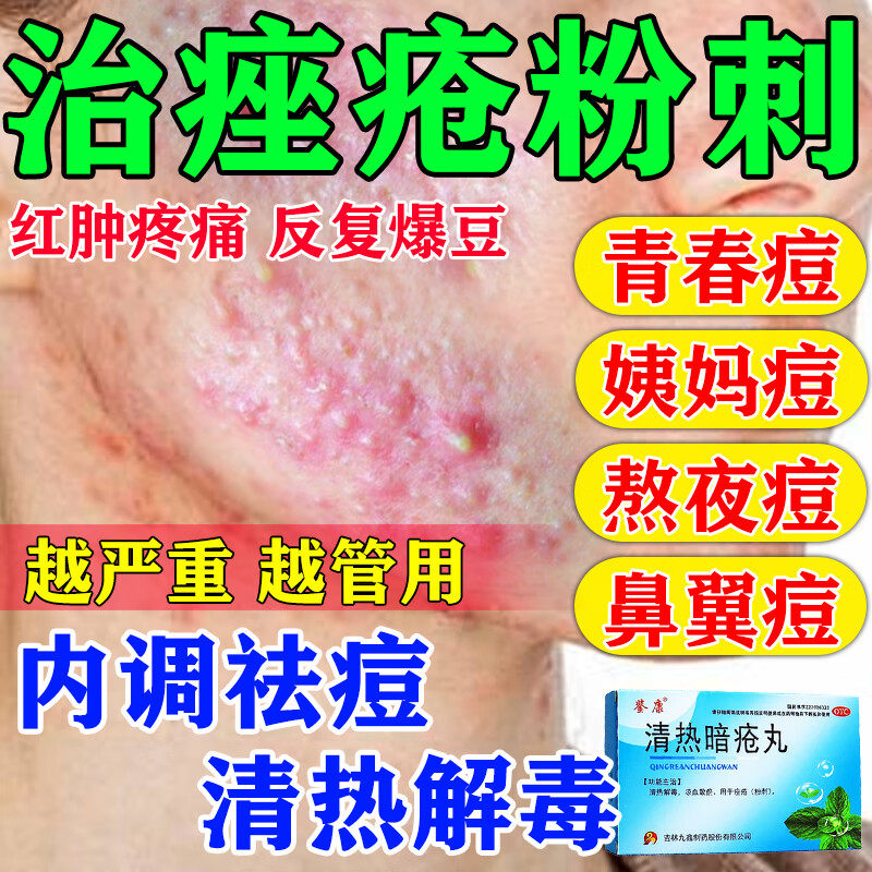治痘痘的药膏祛痘内调口服药脸上长痘痘粉刺脓包疙瘩 清热暗疮丸