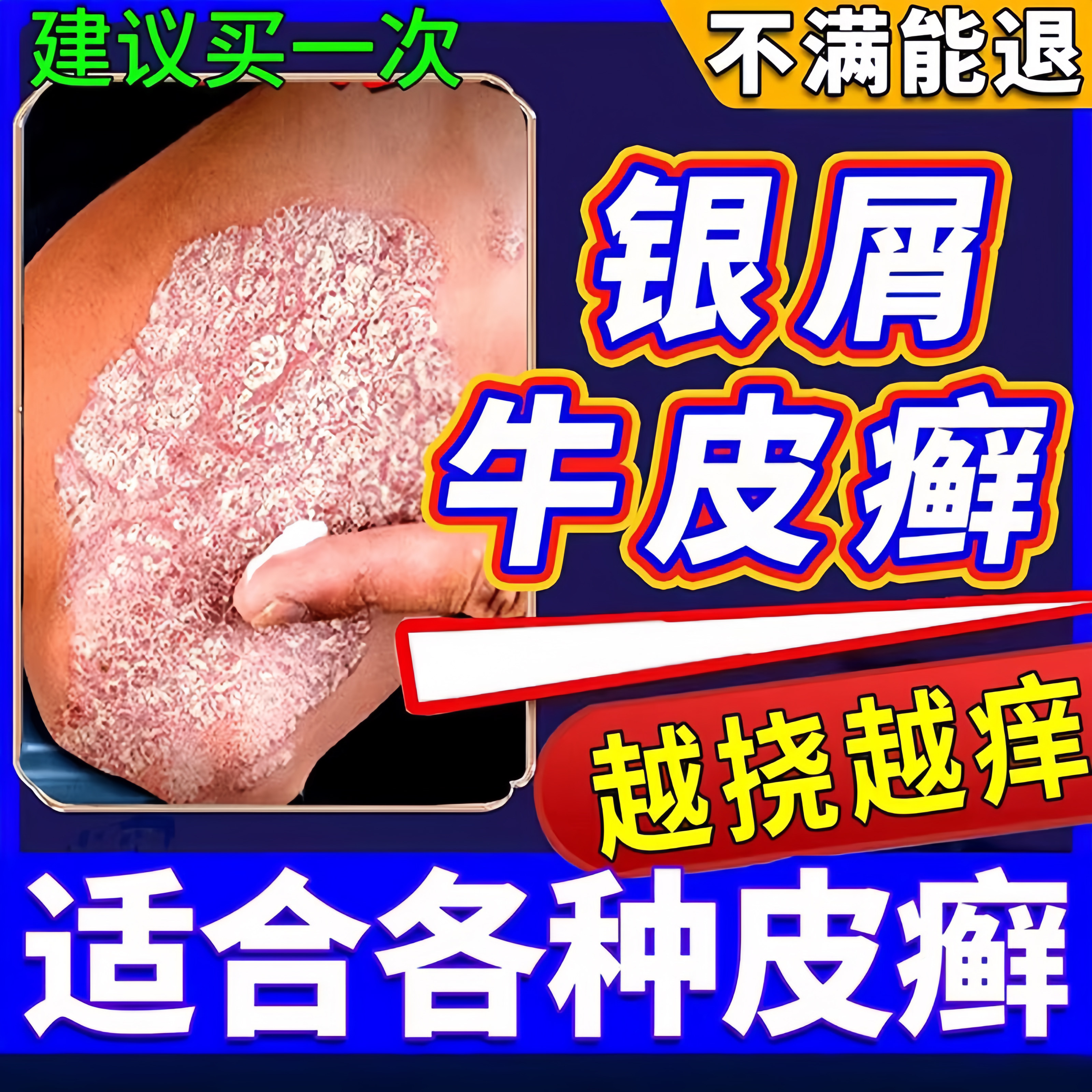 牛皮癣药膏治牛皮癣银屑病皮肤瘙痒体癣皮癣鳞屑皮炎脱皮皮肤止痒