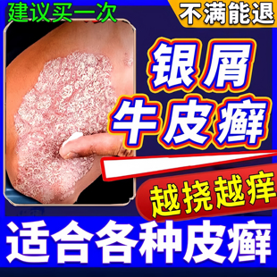牛皮癣药膏治牛皮癣银屑病皮肤瘙痒体癣皮癣鳞屑皮炎脱皮皮肤止痒