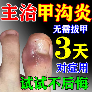 甲沟炎治疗专用药脚趾甲往肉里长消肿去肉芽息肉嵌甲化脓抑菌效药