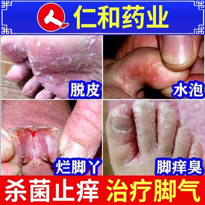 【仁和】硝酸咪康唑乳膏2%*20g*1支/盒