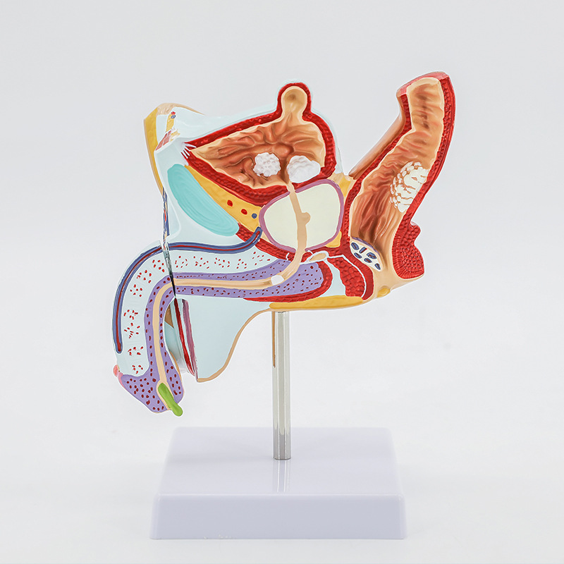 男性内生殖病理模型 男病变生殖解剖模型 男泌尿系统疾病模型
