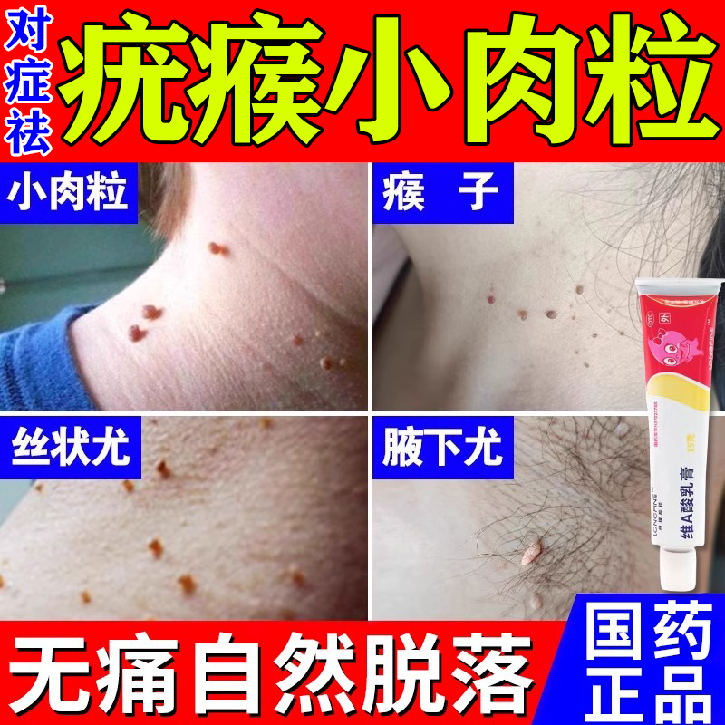 维a酸乳膏去疣专用药膏扁平疣面部去除膏丝状疣治疗祛疣瘊子