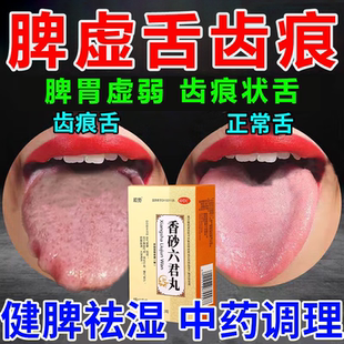 脾虚肝郁脾胃虚弱湿气重肝火旺舌齿痕舌头裂纹苔白厚吃什么药调理